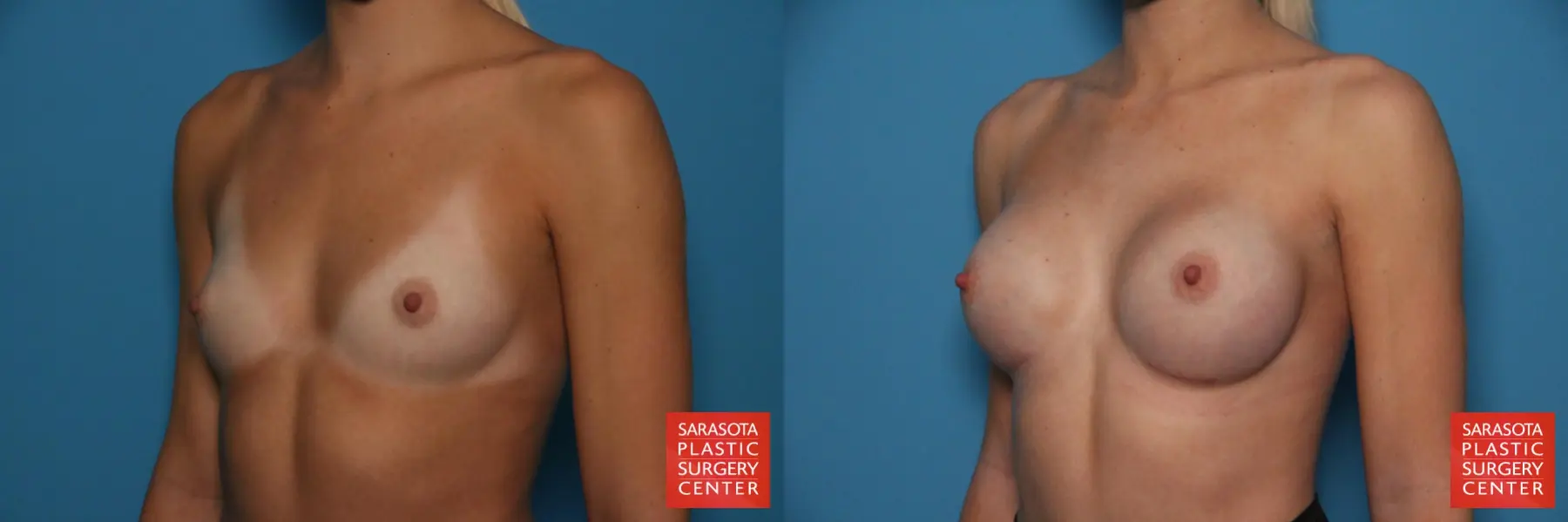 Breast Augmentation: Patient 77 - Before and After 2