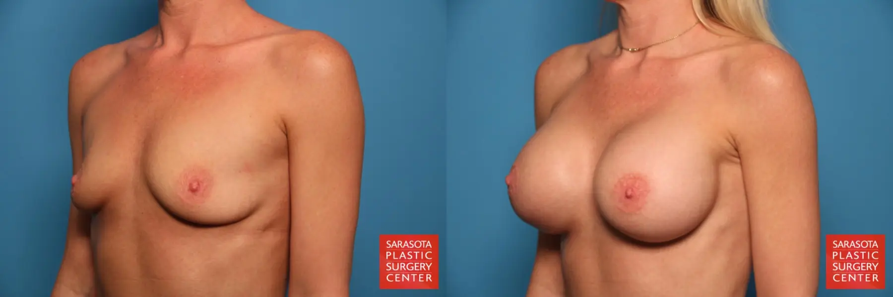 Breast Augmentation: Patient 61 - Before and After 2