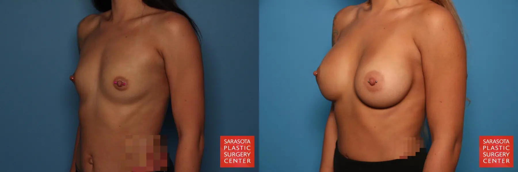 Breast Augmentation: Patient 38 - Before and After 2