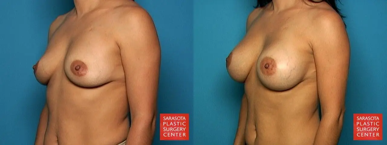 silicone breast augmentation 400cc high profile - Before and After 2