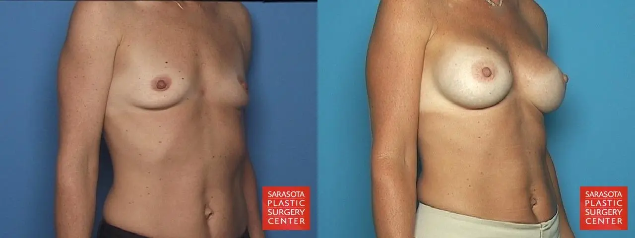 Breast Augmentation: Patient 35 - Before and After 2