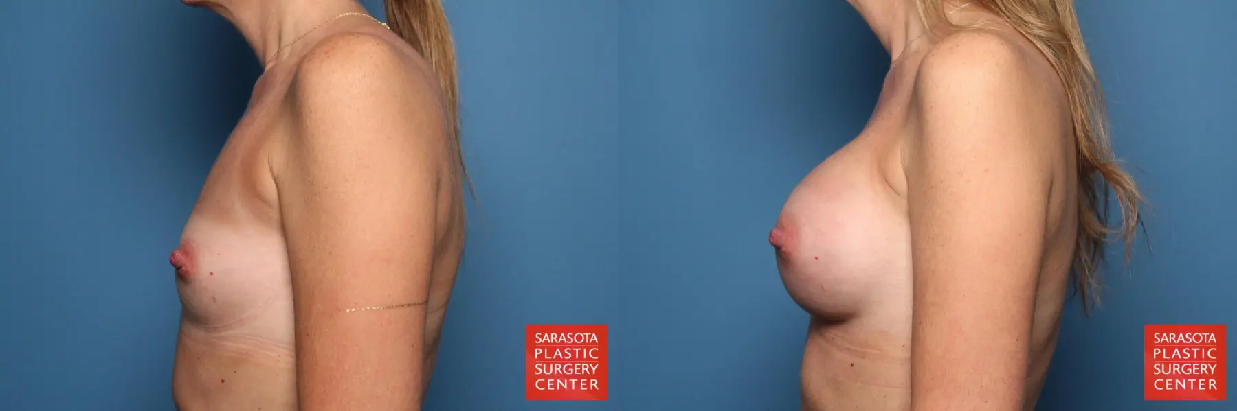 Breast Augmentation: Patient 19 - Before and After 3