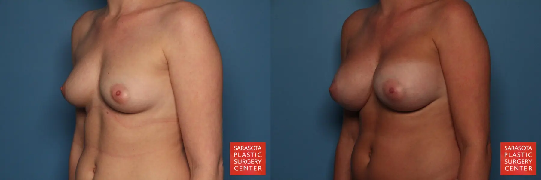Breast Augmentation: Patient 20 - Before and After 2