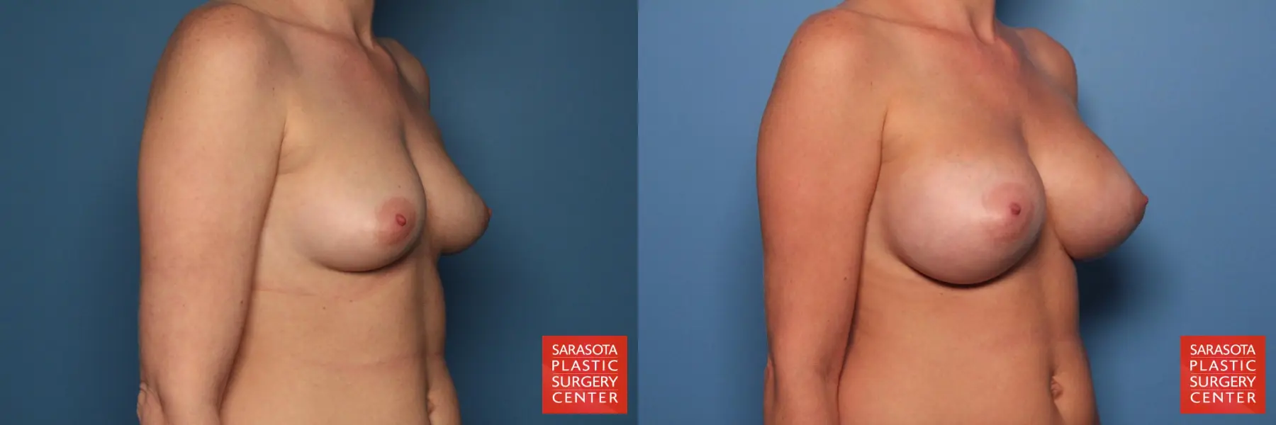 Breast Augmentation: Patient 63 - Before and After 2