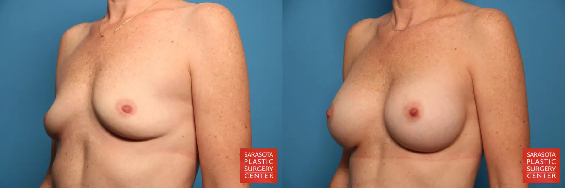 Breast Augmentation: Patient 50 - Before and After 2