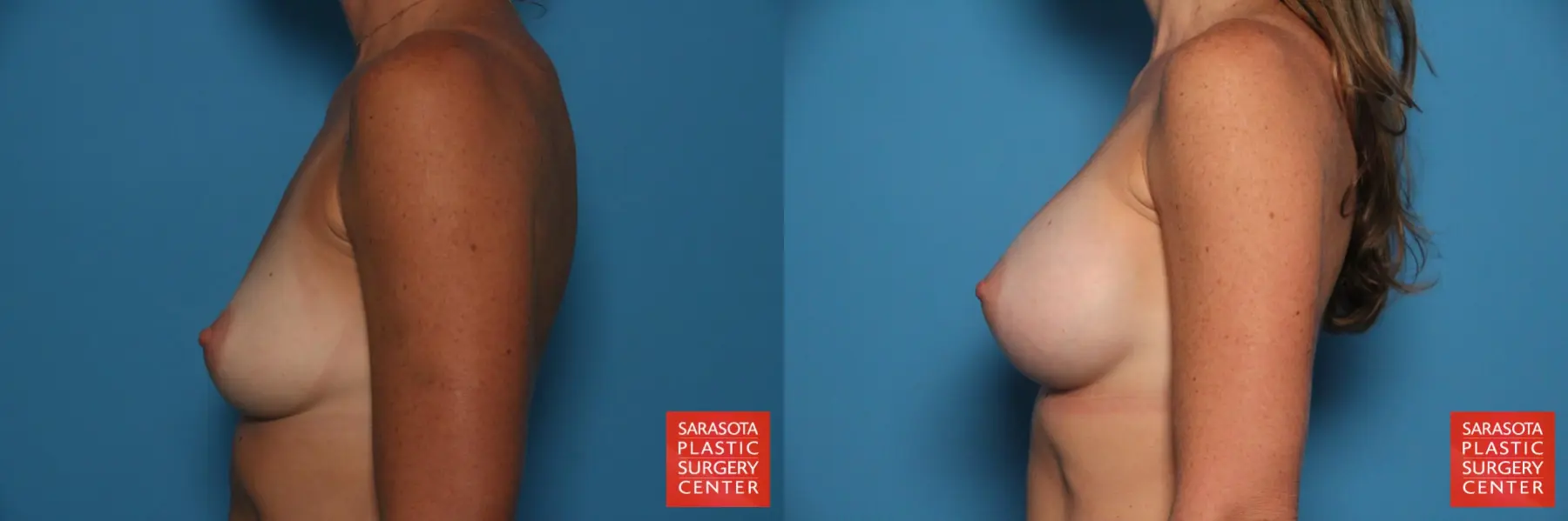 Breast Augmentation: Patient 83 - Before and After 3