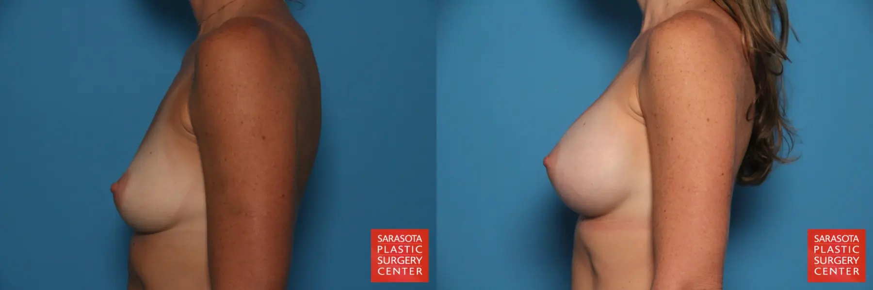 Breast Augmentation: Patient 192 - Before and After 3