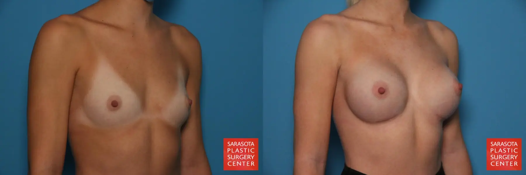 Breast Augmentation: Patient 77 - Before and After 4