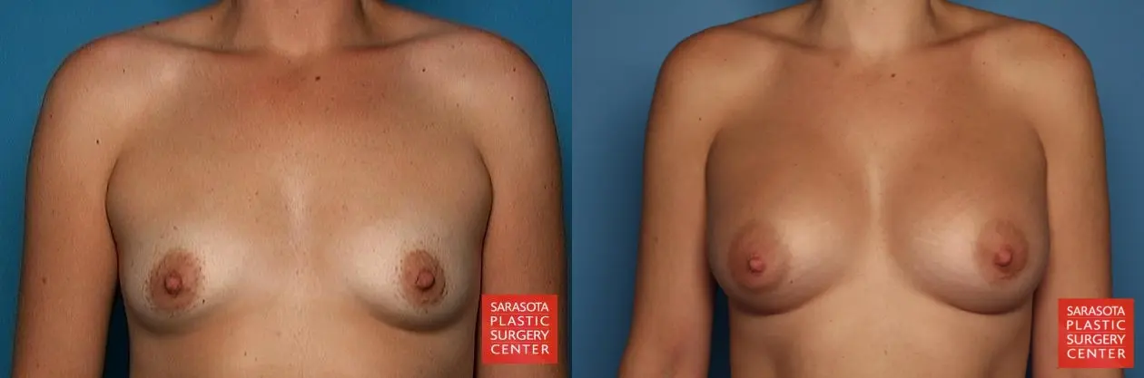 Breast Augmentation: Patient 18 - Before and After 1