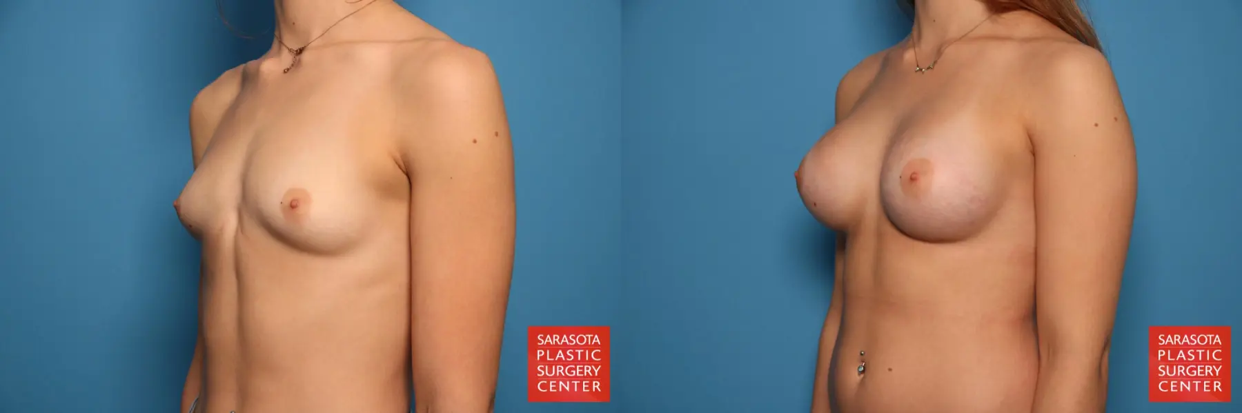 Breast Augmentation: Patient 26 - Before and After 2