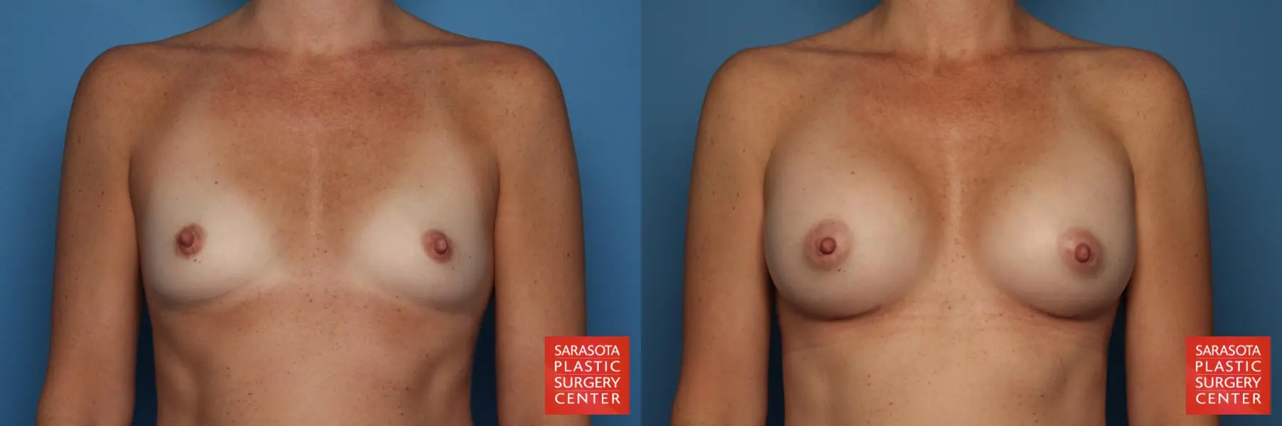 Breast Augmentation: Patient 30 - Before and After  