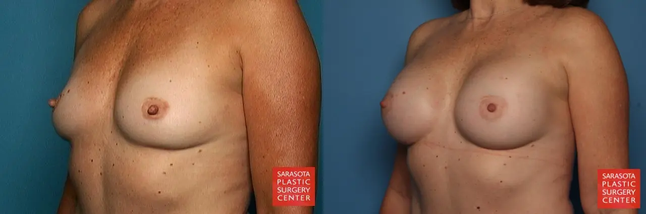 Breast Augmentation: Patient 48 - Before and After 2
