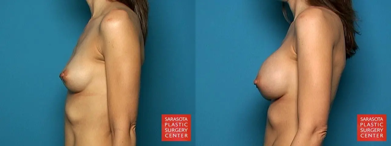Breast Augmentation: Patient 50 - Before and After 3