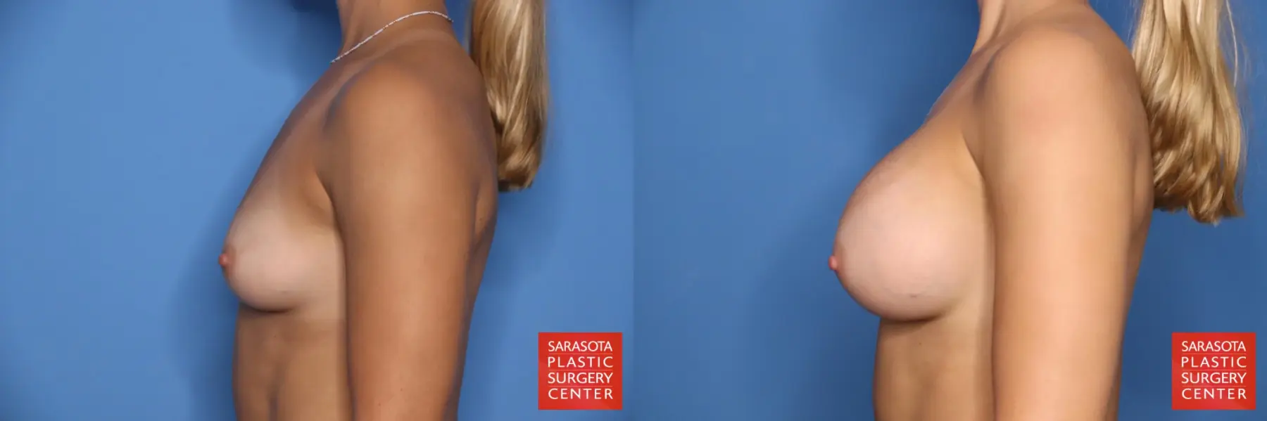 Breast Augmentation: Patient 73 - Before and After 3