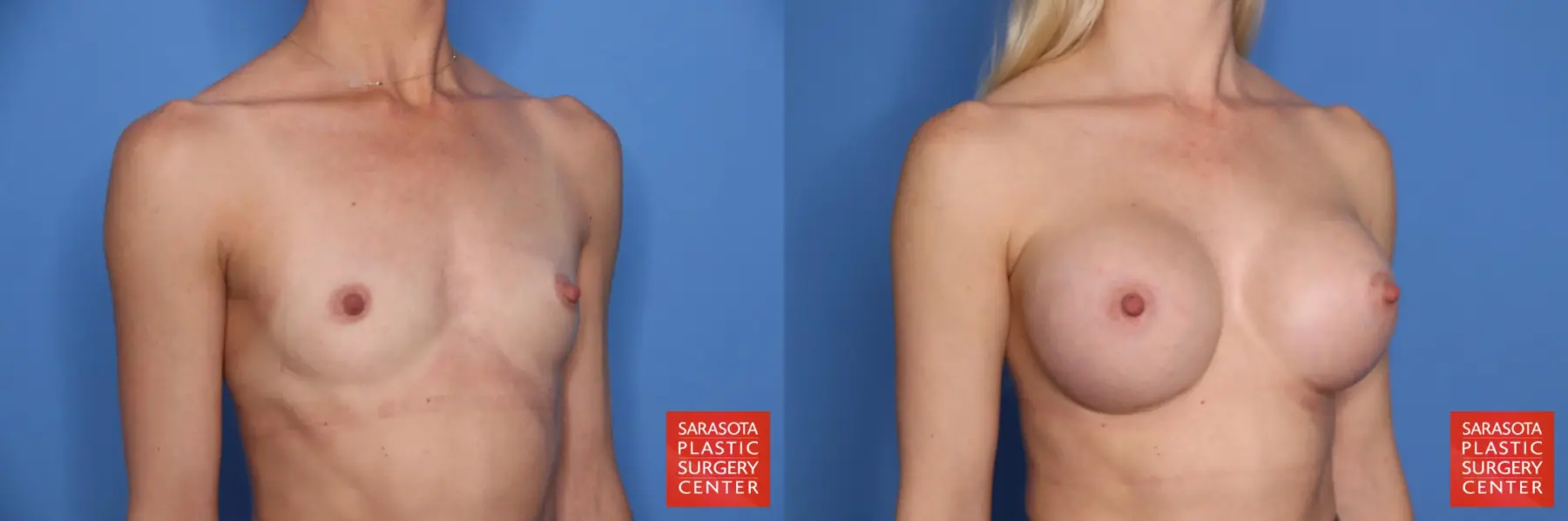 Breast Augmentation: Patient 203 - Before and After 2
