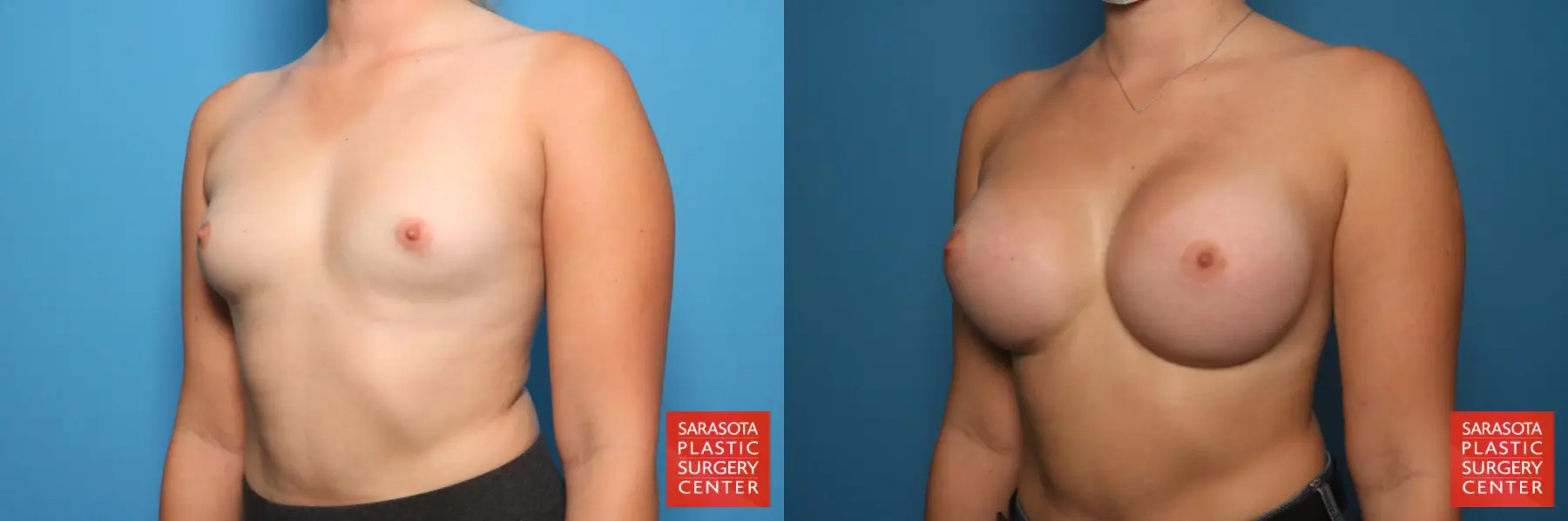 Breast Augmentation: Patient 72 - Before and After 2