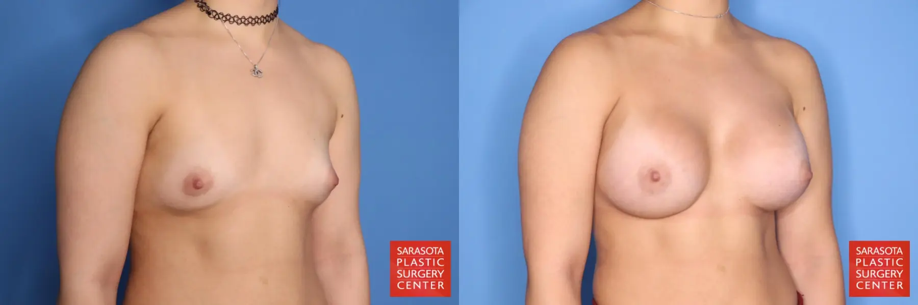 Breast Augmentation: Patient 212 - Before and After 4