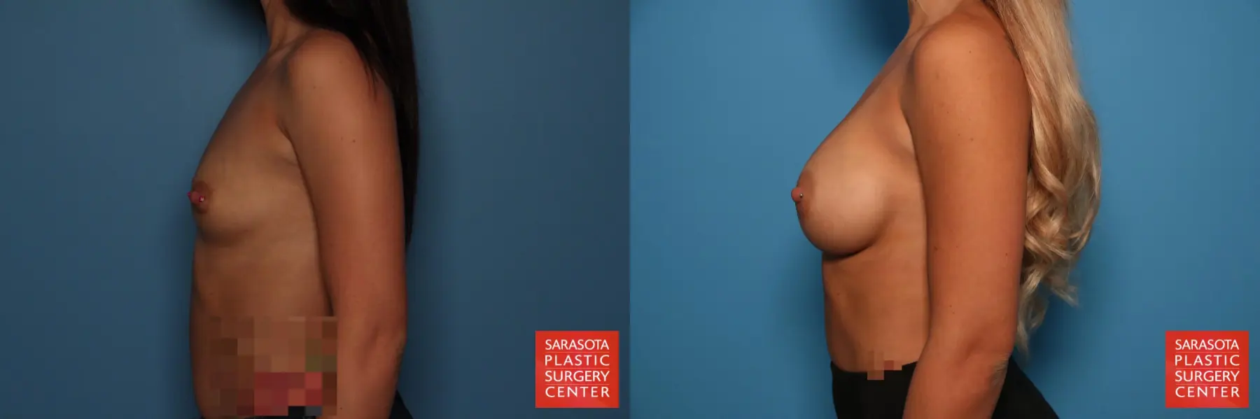 Breast Augmentation: Patient 38 - Before and After 3