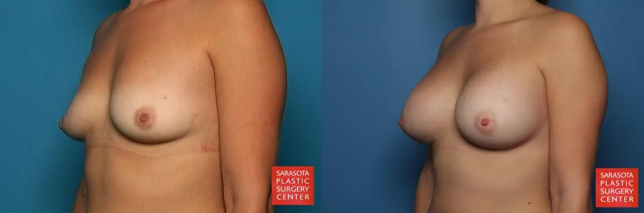 Breast Augmentation: Patient 51 - Before and After 2