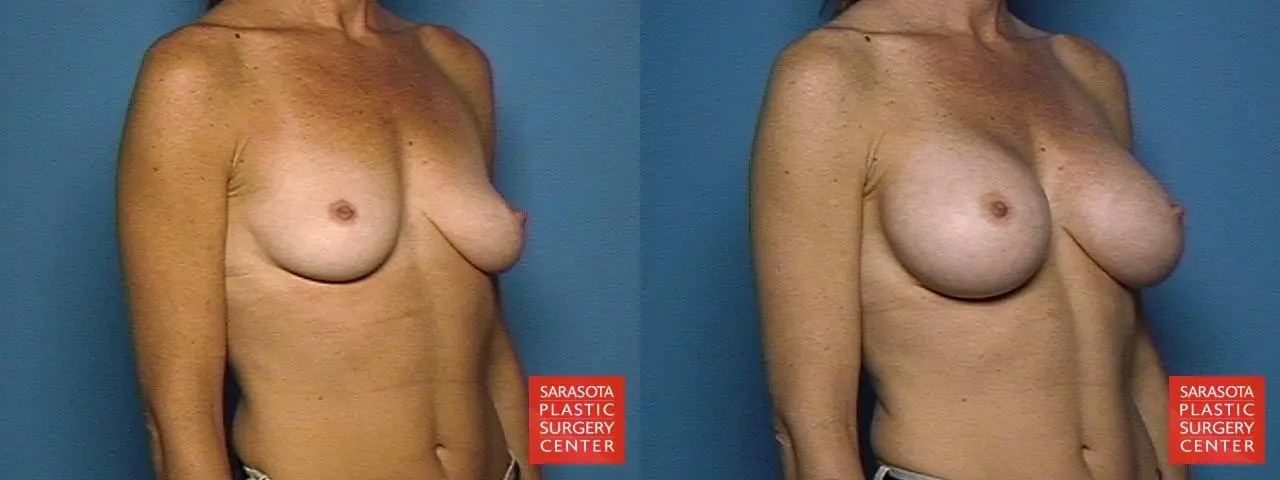 Breast Augmentation: Patient 37 - Before and After 4