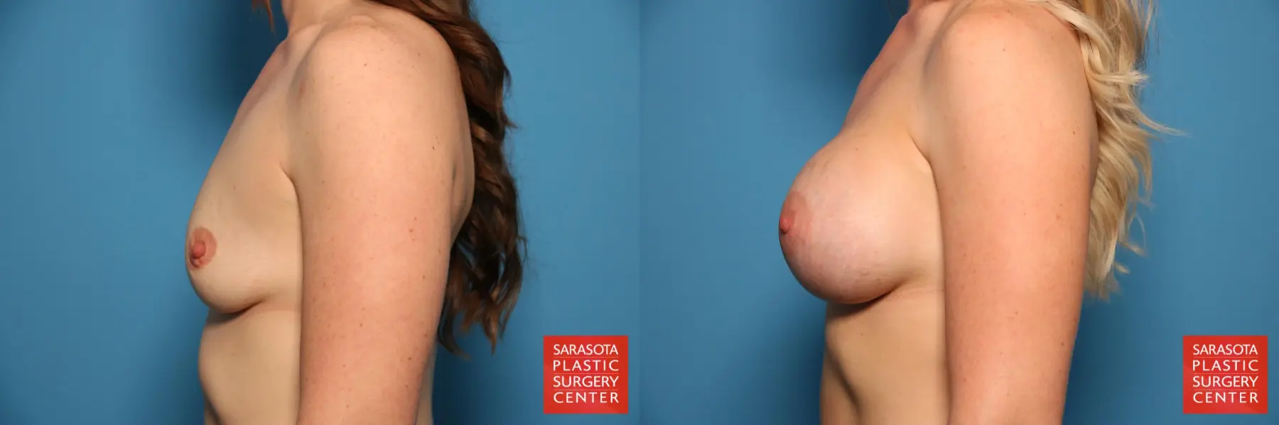 Breast Augmentation: Patient 9 - Before and After 3