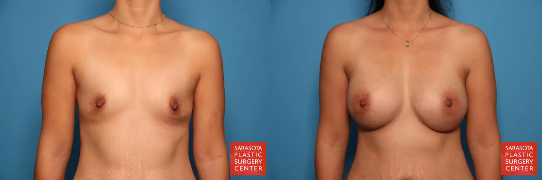 Breast Augmentation: Patient 28 - Before and After 1