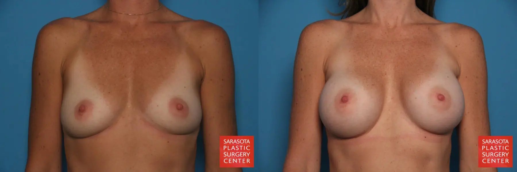 Breast Augmentation: Patient 83 - Before and After 1