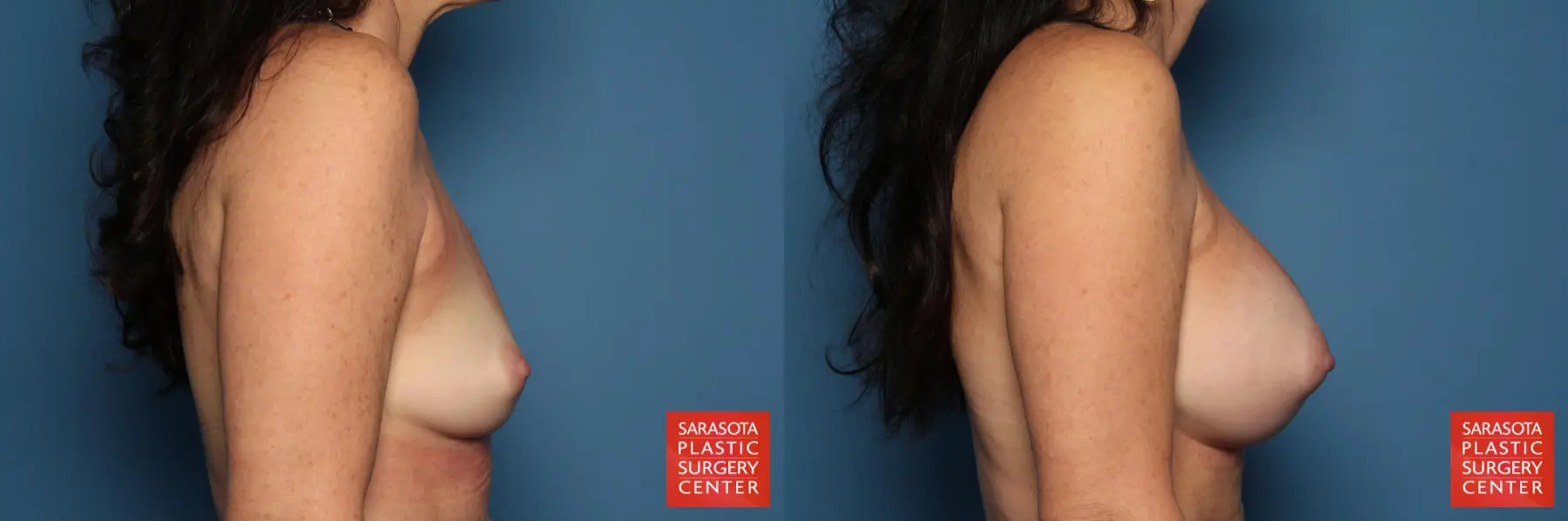 Breast Augmentation: Patient 41 - Before and After 3