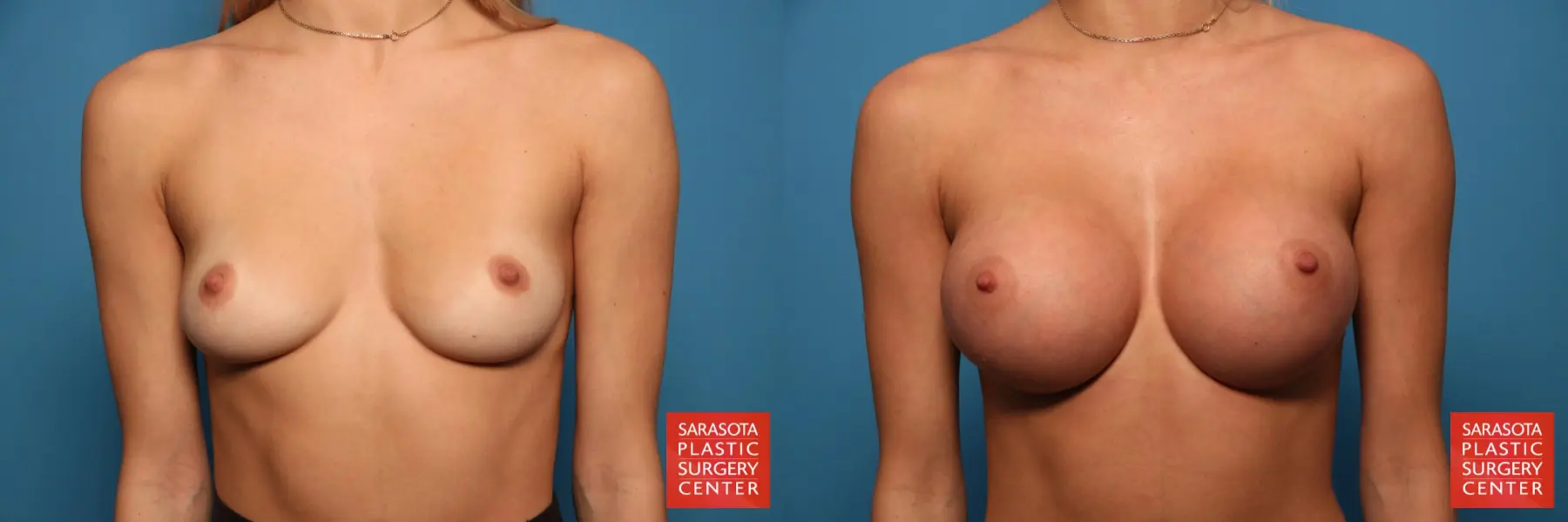 Breast Augmentation: Patient 8 - Before and After 1