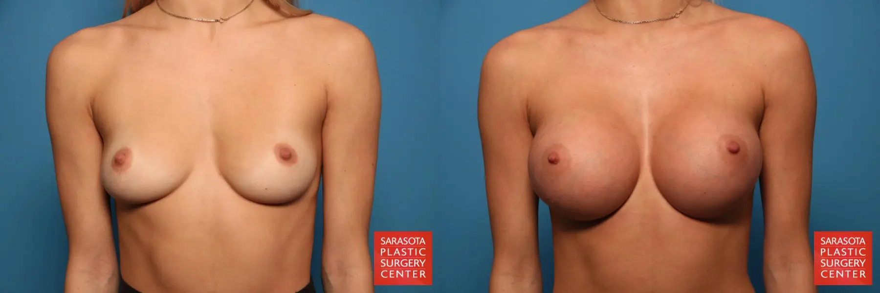 Breast Augmentation: Patient 7 - Before and After  