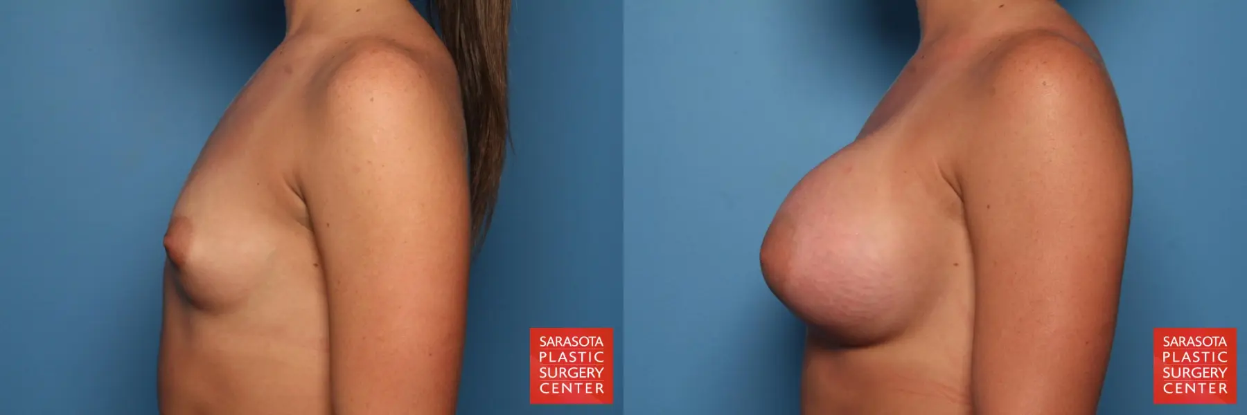 Breast Augmentation: Patient 65 - Before and After 3