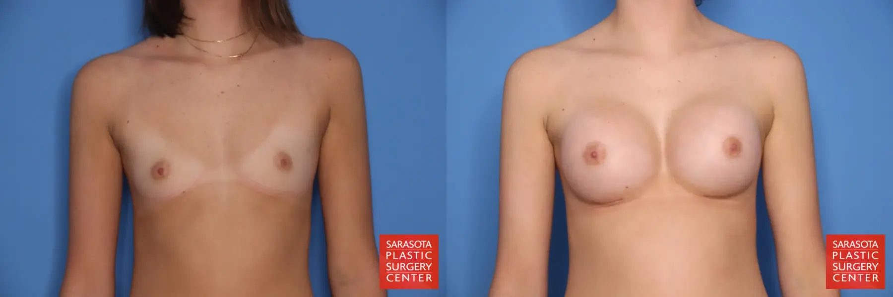 Breast Augmentation: Patient 69 - Before and After 1