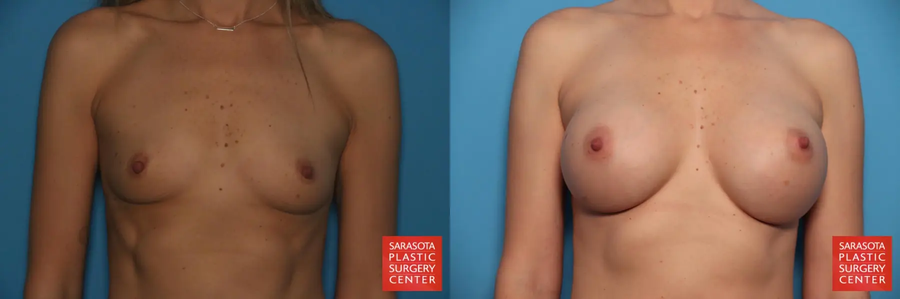 Breast Augmentation: Patient 76 - Before and After 1
