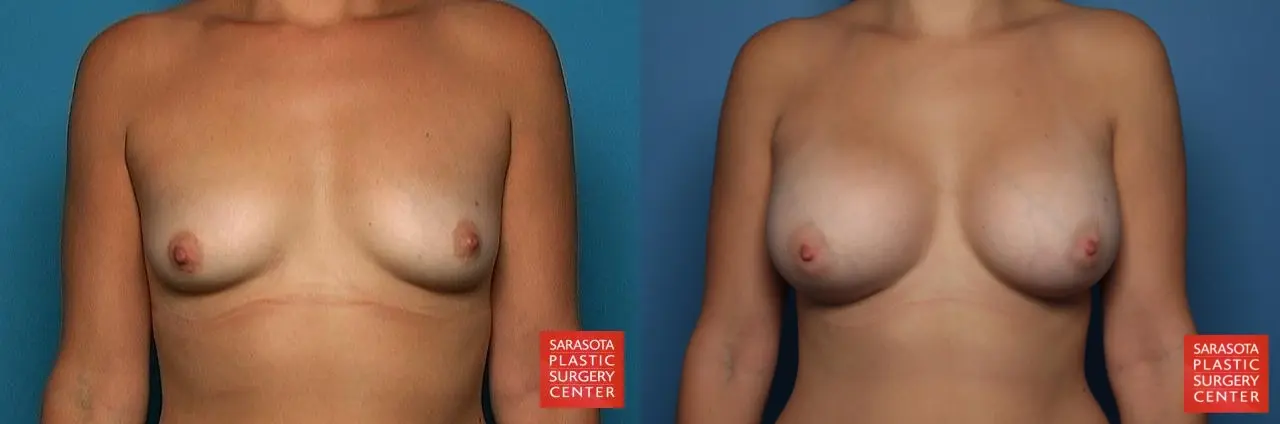 Breast Augmentation: Patient 51 - Before and After 1