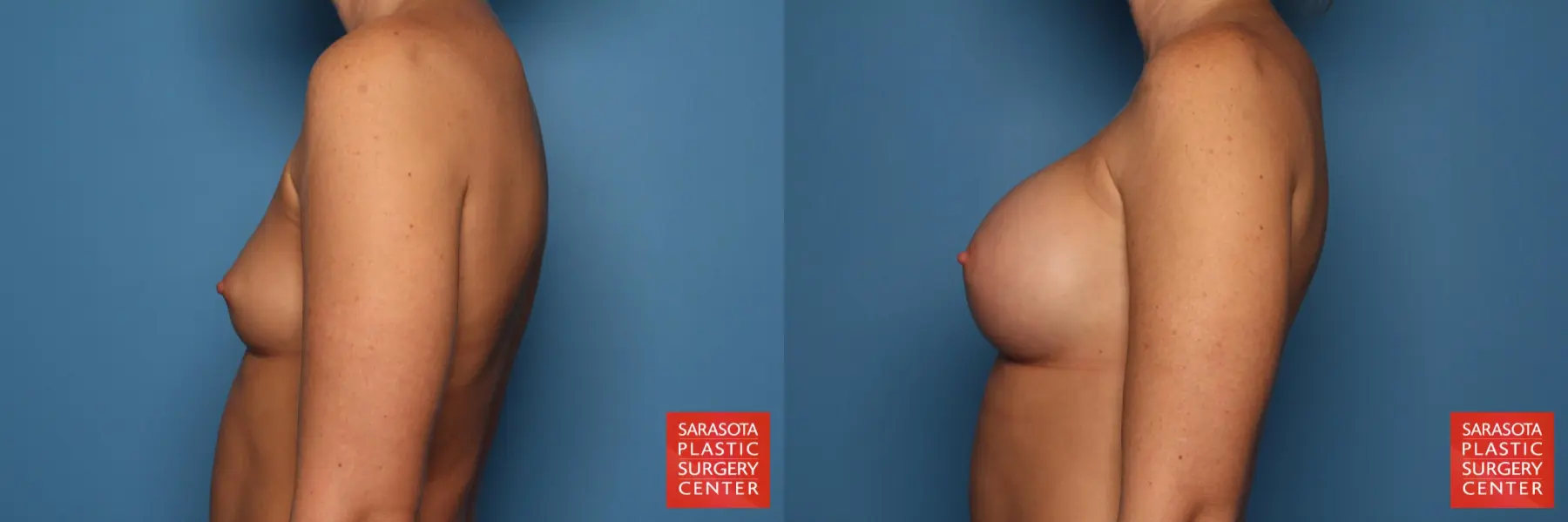 Breast Augmentation: Patient 1 - Before and After 3