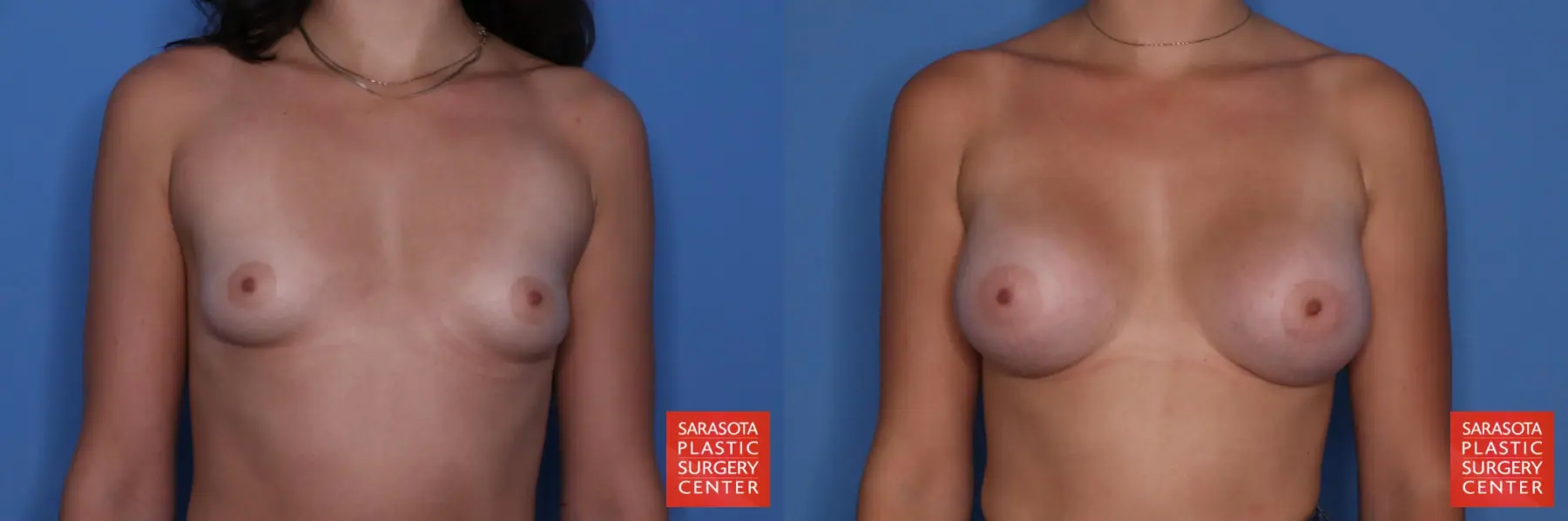 Breast Augmentation: Patient 75 - Before and After 1