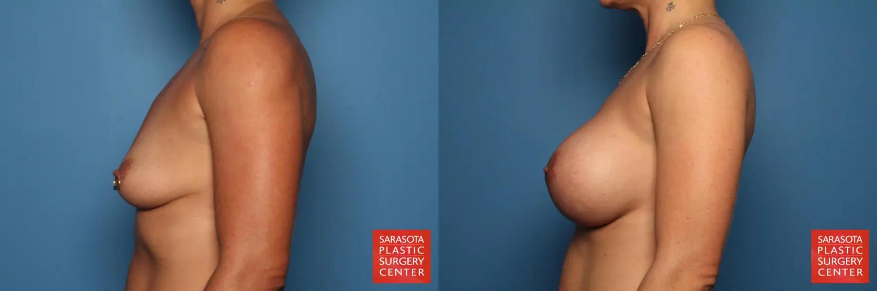 Breast Augmentation: Patient 56 - Before and After 3