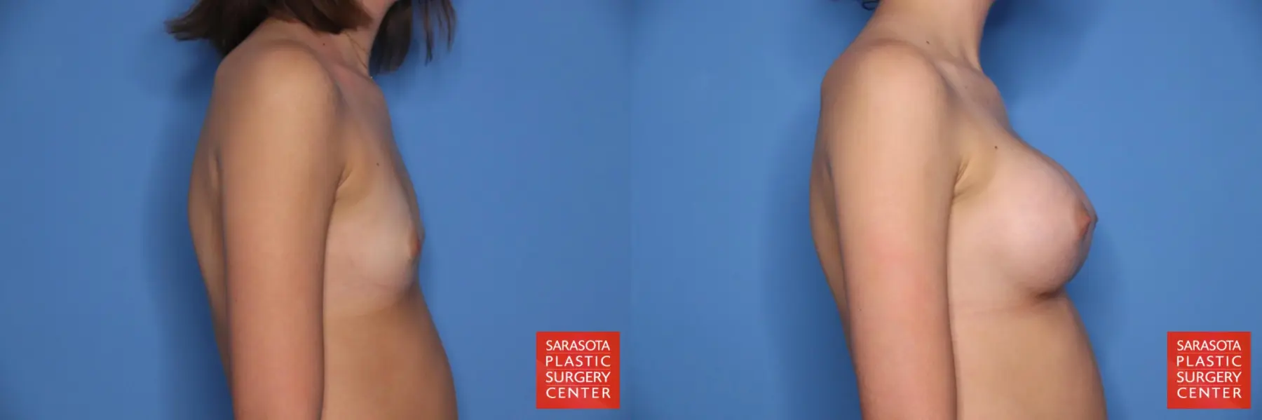 Breast Augmentation: Patient 69 - Before and After 3