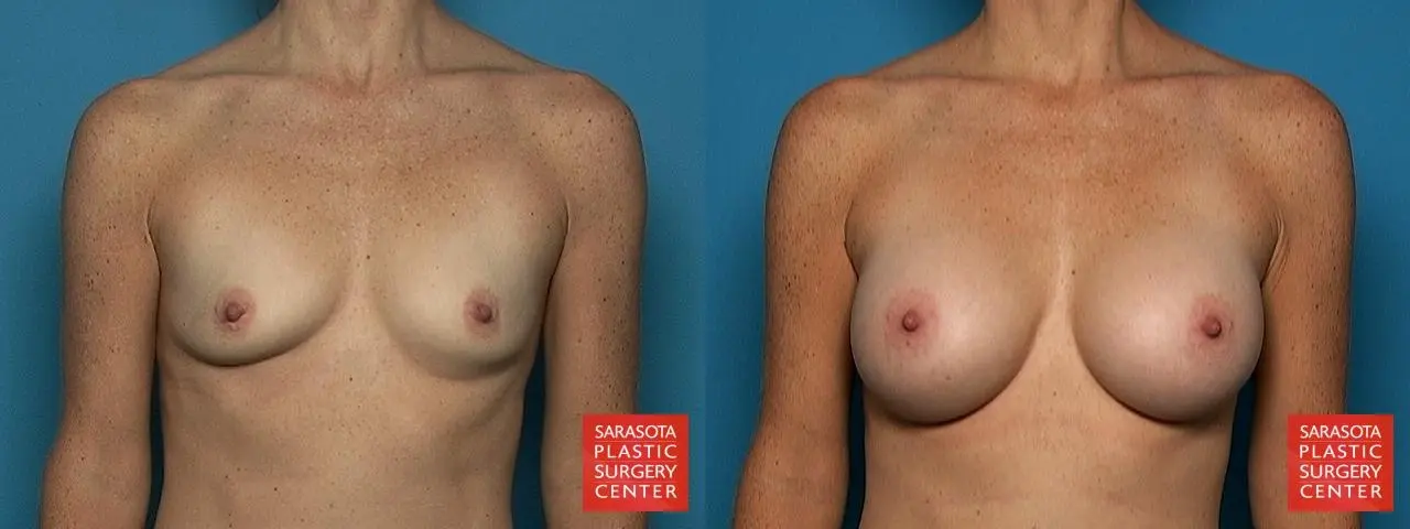 Breast Augmentation: Patient 8 - Before and After  