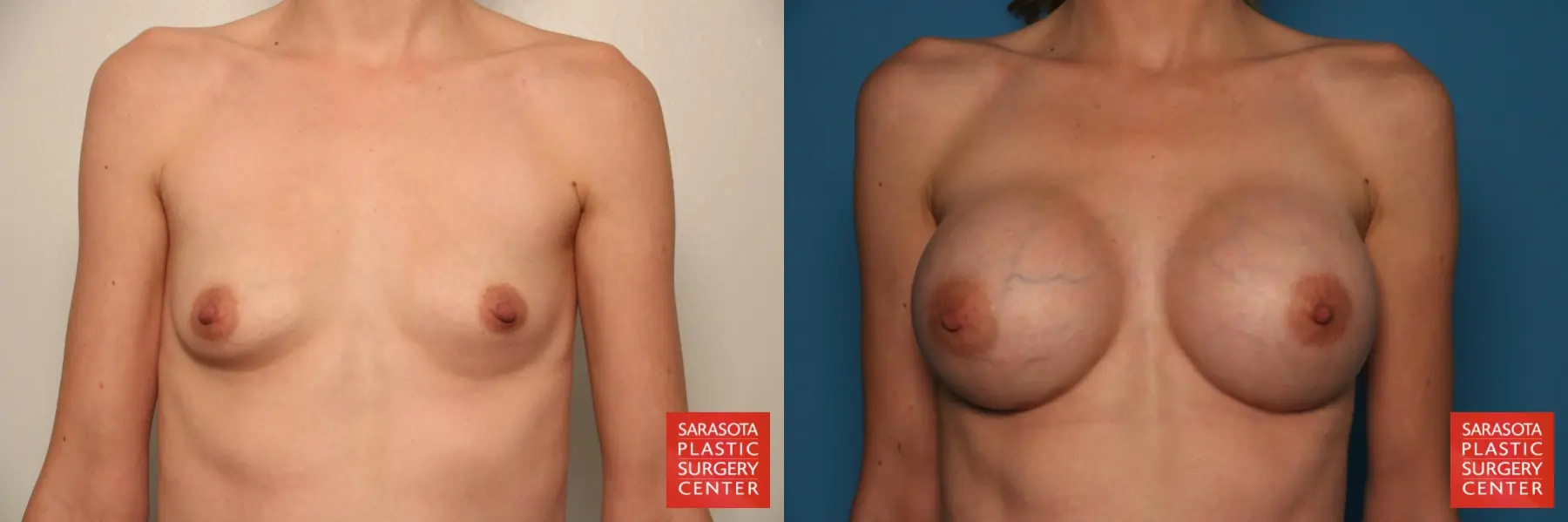 Breast Augmentation: Patient 62 - Before and After 1