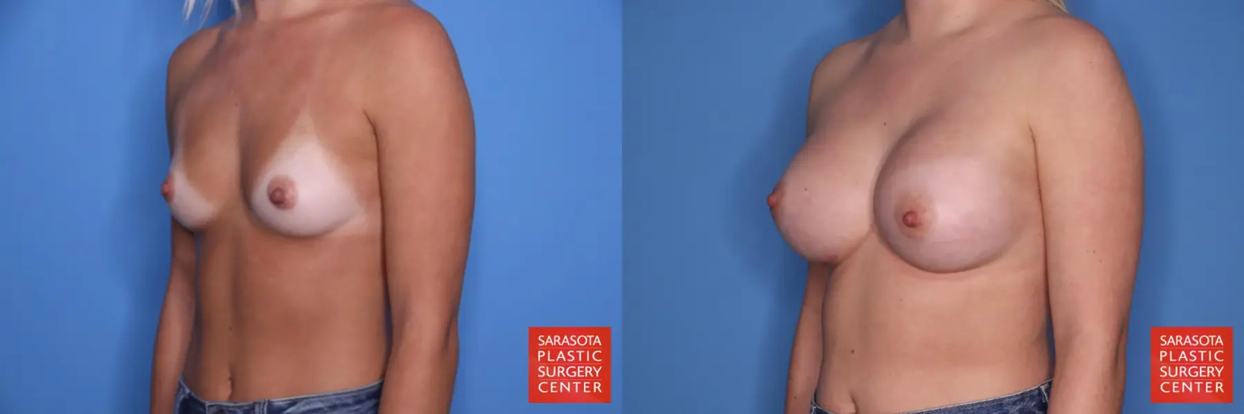 Breast Augmentation: Patient 202 - Before and After 2