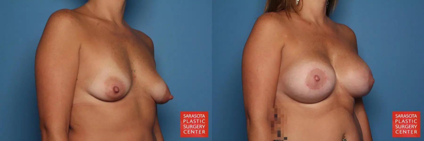 Breast Augmentation With Lift: Patient 31 - Before and After 2