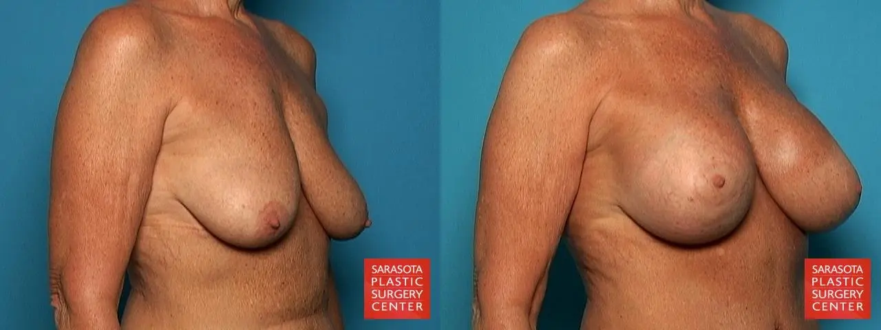 Breast Augmentation With Lift: Patient 4 - Before and After 2
