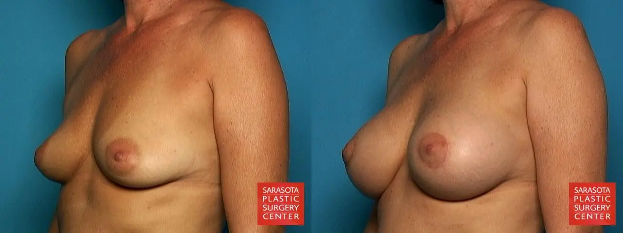 Breast Augmentation With Lift: Patient 1 - Before and After 2