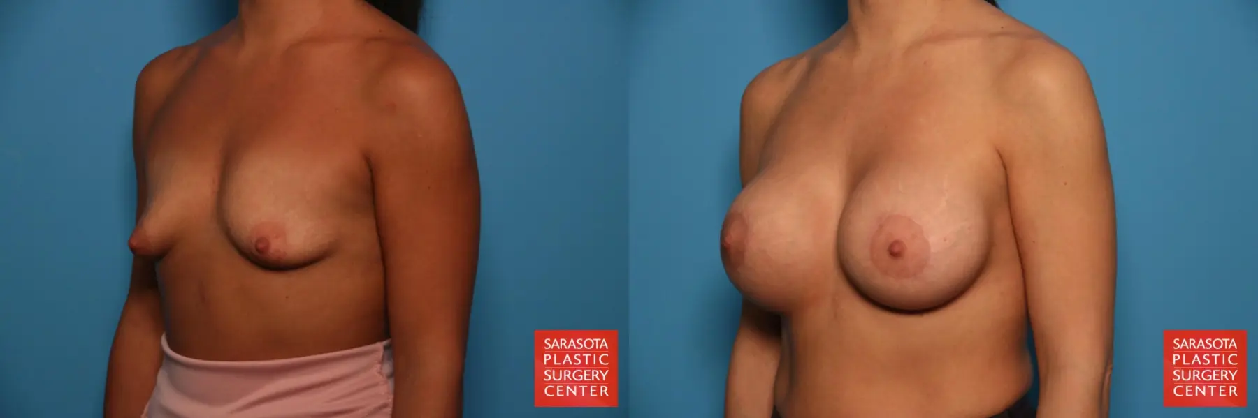 Breast Augmentation With Lift: Patient 35 - Before and After 2
