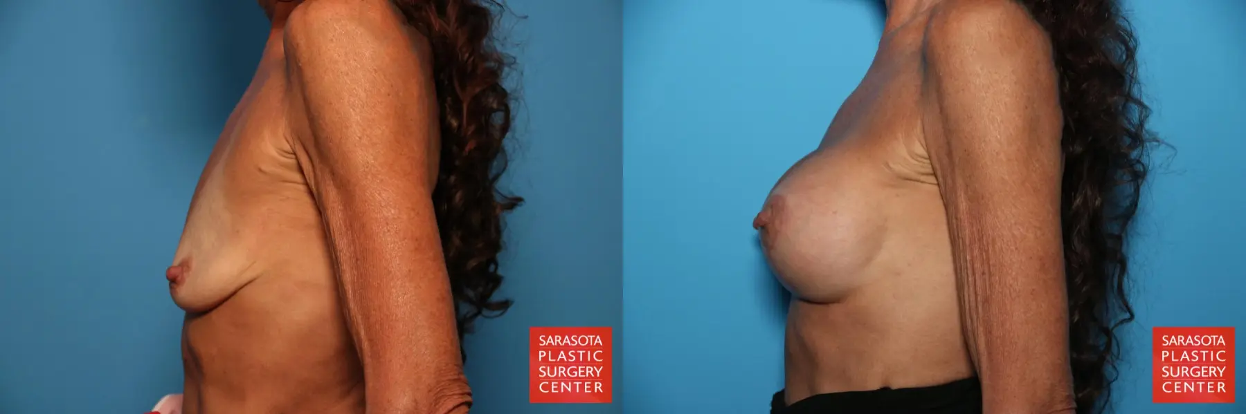 Breast Augmentation With Lift: Patient 22 - Before and After 3