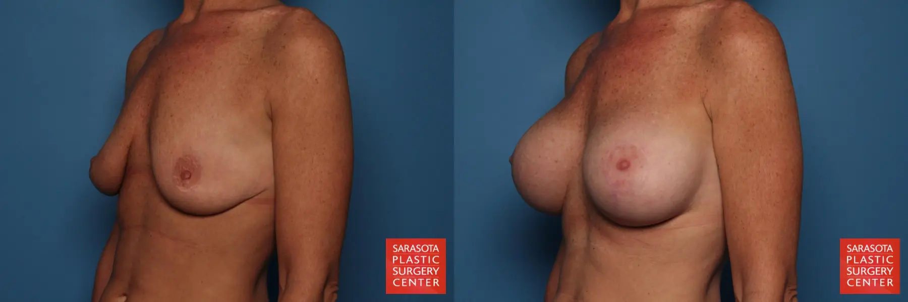 Breast Augmentation With Lift: Patient 26 - Before and After 2