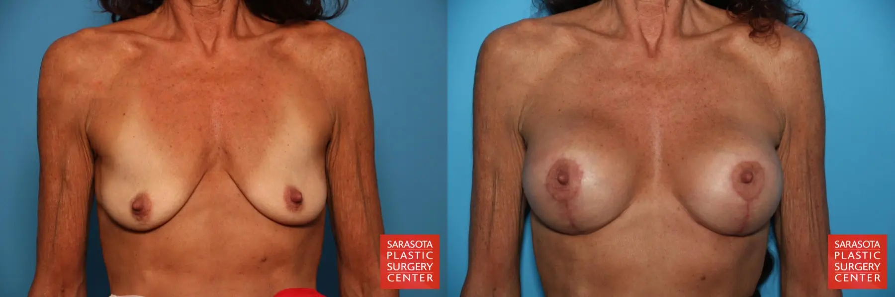 Breast Augmentation With Lift: Patient 22 - Before and After  