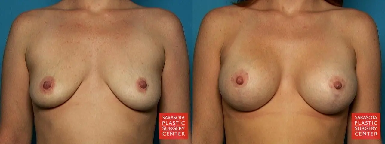 Breast Augmentation With Lift: Patient 2 - Before and After 1