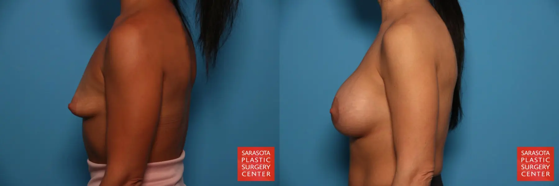 Breast Augmentation With Lift: Patient 35 - Before and After 3